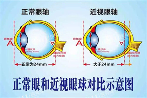 正常眼和近视眼球对比示意图
