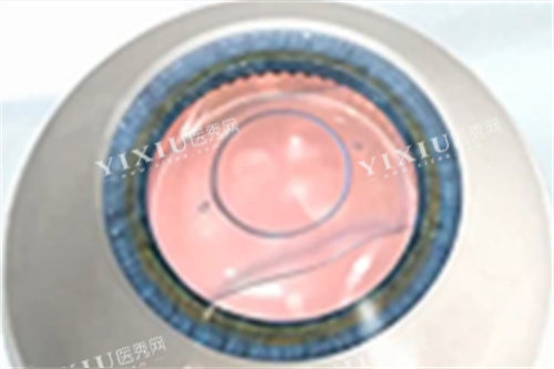ICL晶体手术完成