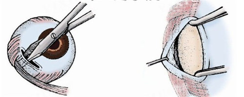 斜视下斜肌手术