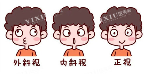 斜视的种类