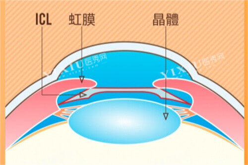 ICL示意图
