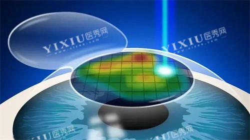 个性化微飞秒手术过程图片