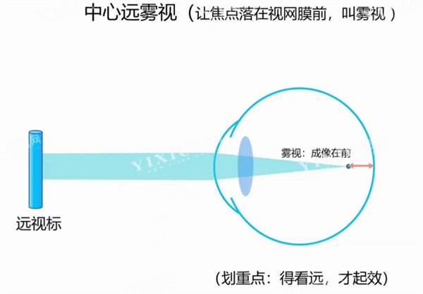 离焦眼镜治疗近视原理图解
