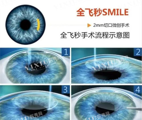 全飞秒近视手术流程图