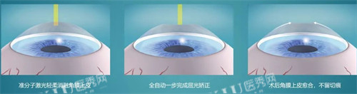 近视手术简要流程