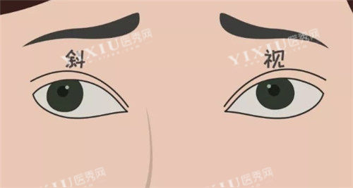 斜视眼珠表现图
