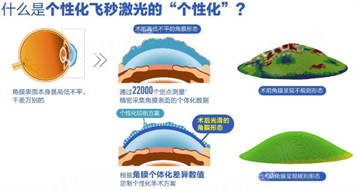 什么是个性化飞秒