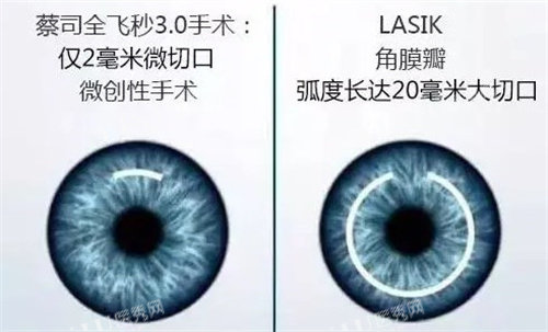 蔡司全飞秒3.0手术和LASIK对比