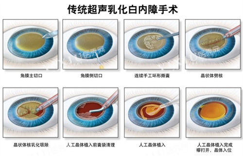 白内障超声乳化手术流程图