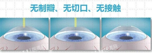 飞秒近视手术