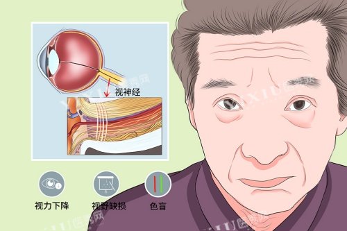 视神经萎缩症状展示图