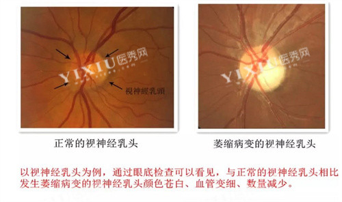 视神经萎缩对比