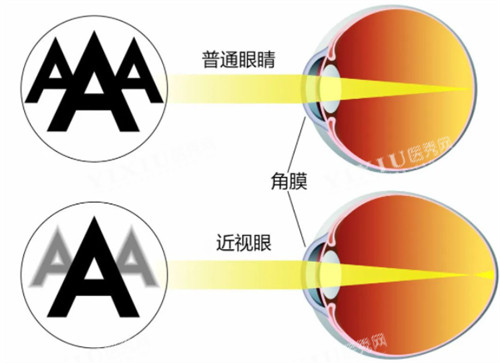 近视眼镜与正常眼睛视物区别