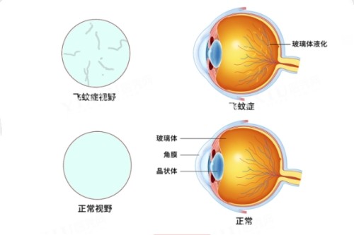 飞蚊症视野和正常视野对比图