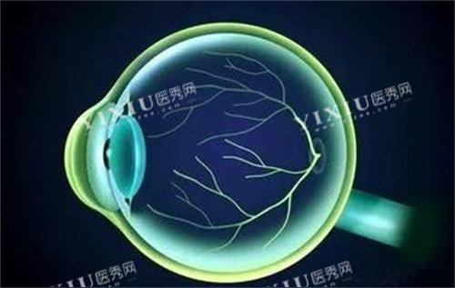 飞蚊症眼球