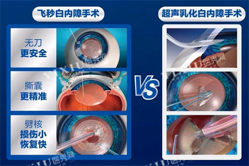 飞秒白内障手术过程