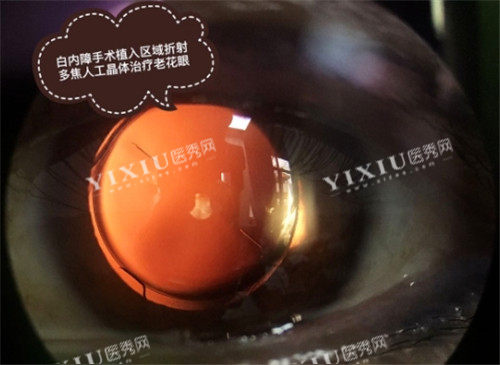 白内障手术细节图 (2)