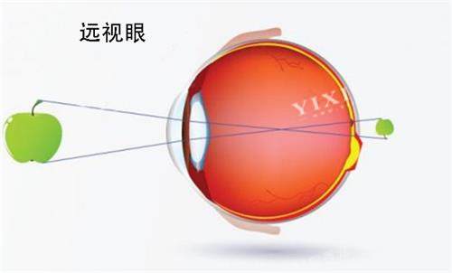远视眼睛的视力