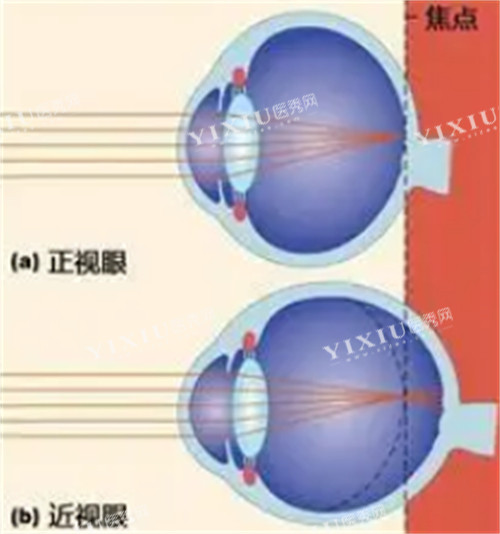 正常眼睛和近视眼镜的不同