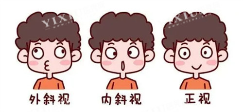 外斜内斜和正常眼睛的对比图