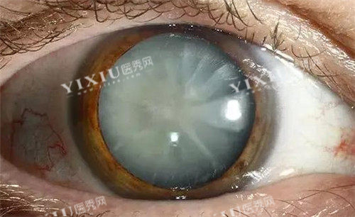 白内障眼球照片