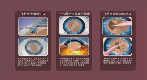 2026年白内障手术报销比例详解!统一回复:不同地区报销额度有差异要注意!