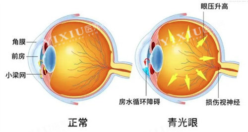 急性闭角型青光眼