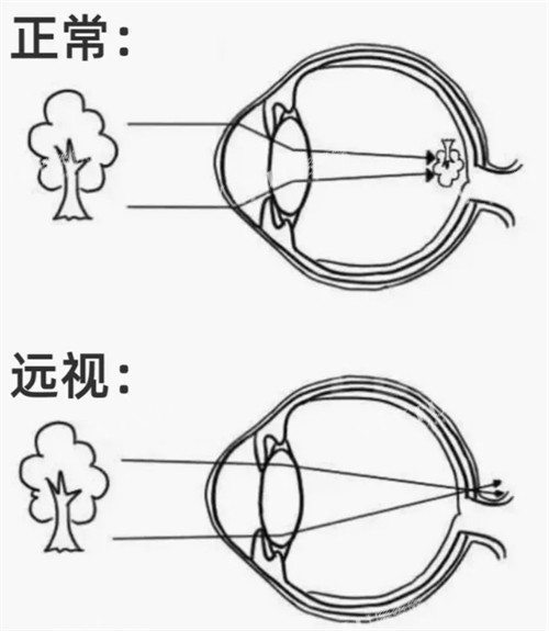 正常眼镜和远视眼睛