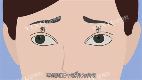 斜视动画示意图