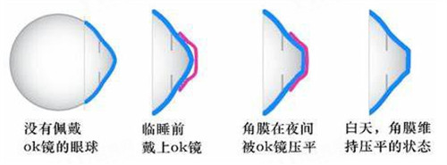 角膜塑形镜多少钱