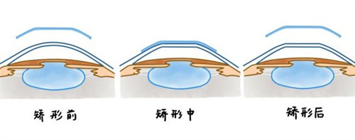 角膜塑形镜能控制眼轴增长吗?眼科医师验证+临床数据支持,青少年近视防控有效!