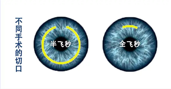 兰州全飞秒手术哪家强?华厦|爱尔|普瑞三家深度对比不踩坑