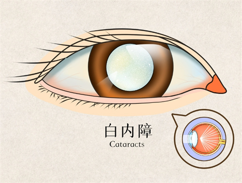 北京做白内障手术需要多少钱?传统超声乳化手术8000元起、人工晶体1万元起、传统3000元起~