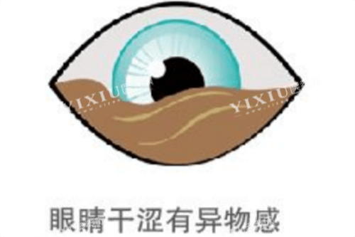 眼睛干涩有异物感