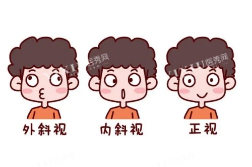 眼睛内斜视外斜视正常眼睛对比图