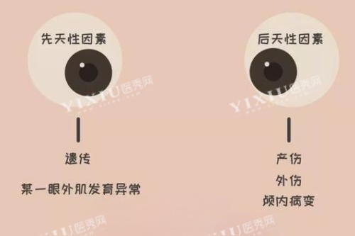眼睛斜视产生原因卡通图片