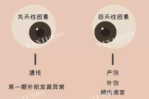 斜视眼睛照片图
