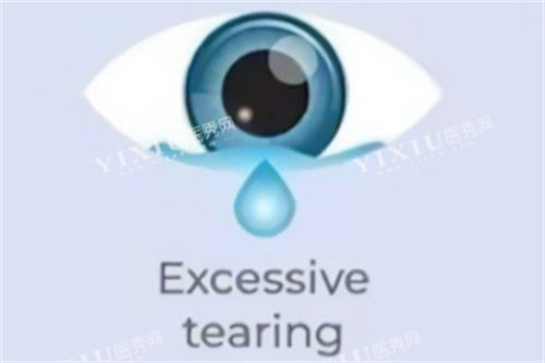 眼睛多泪示意图