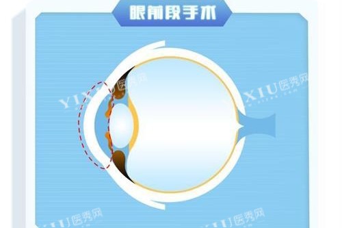 眼前段近视手术示意图