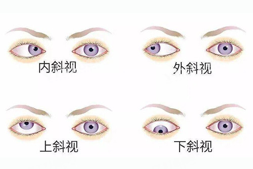 眼睛斜视不同类型分享