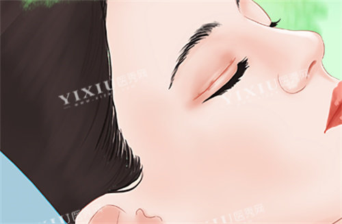 需要双眼皮修复的眼睛