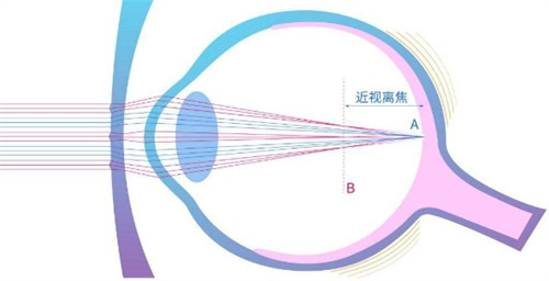 罗教司得迈控适合哪些孩子?主要适用于6至17岁已经出现近视问题的青少年儿童