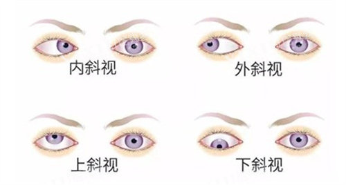内外斜视、上下斜视