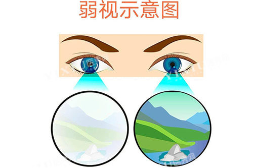 弱视示意图