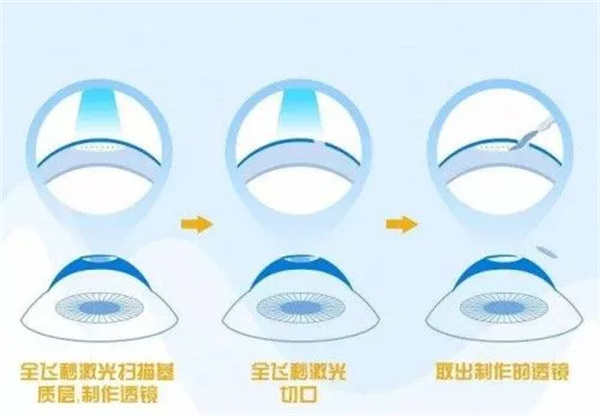 在徐州做全飞秒手术要花多少钱?复兴爱尔瑞博价格全揭秘