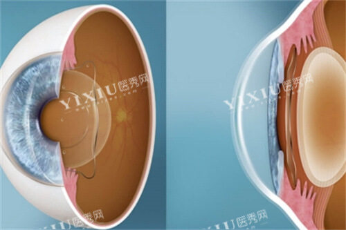 ICL晶体切面图
