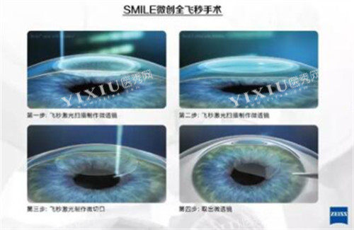 全飞秒手术过程图解