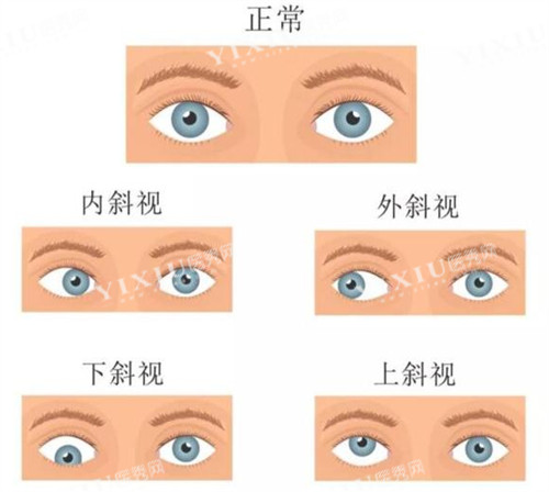 不同情况的斜视眼睛