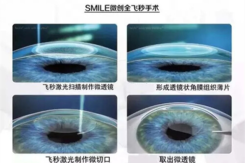 邢台眼科医院价格表2025年:全飞秒15800元起、白内障超声乳化3800元起、医学验光68元起!