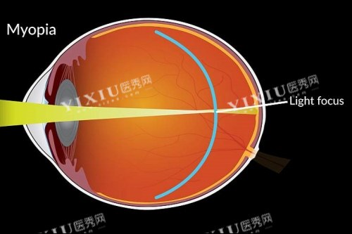 近视成像落在视网膜前